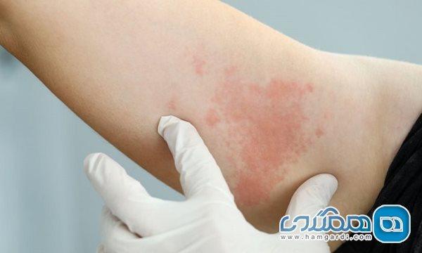 کهیر مزمن و تاثیر آن بر کیفیت زندگی انسان